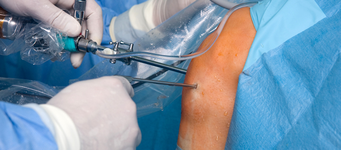 HighQuality Best Arthroscopic Surgery In India [2020]