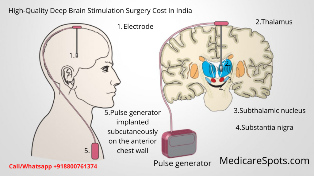Low Cost Deep Brain Stimulation Dbs Surgery In India